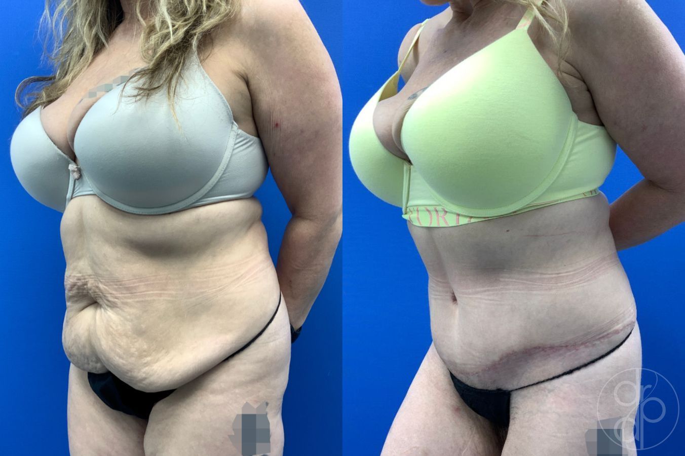 Before and after Abdominoplasty case 46426 - Angle 3
