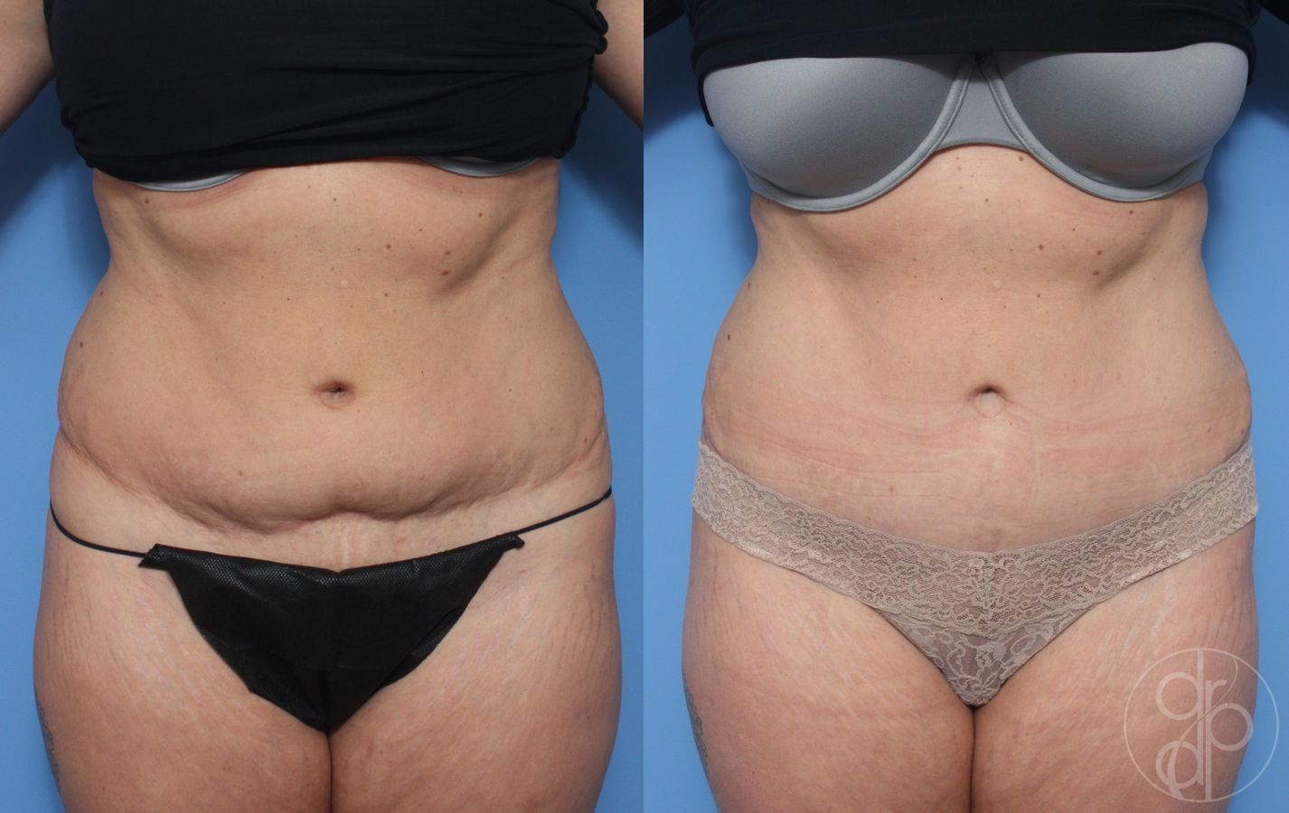 Before and after Abdominoplasty case 29550
