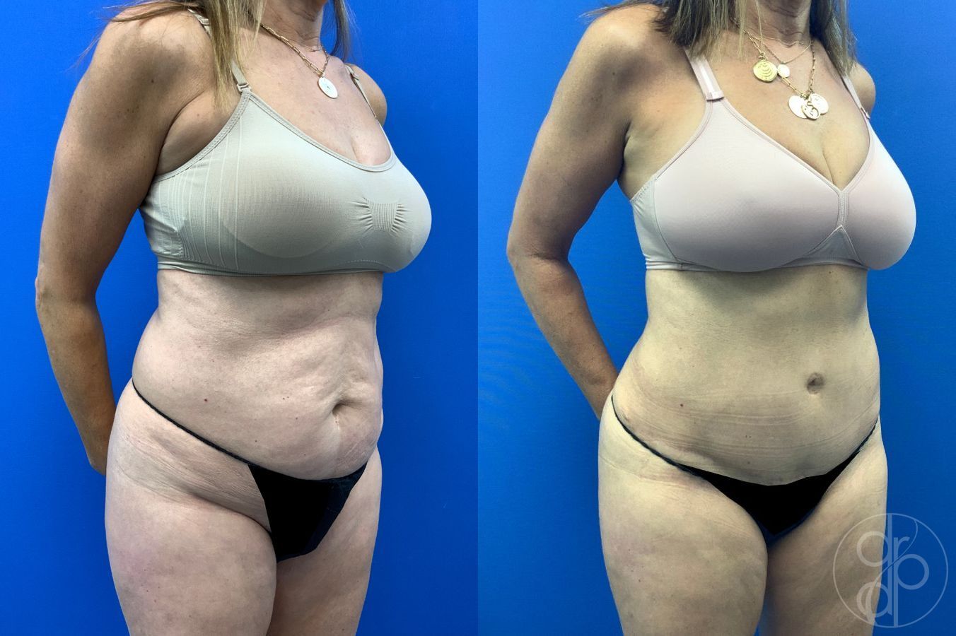Before and after Abdominoplasty case 46404 - Angle 9