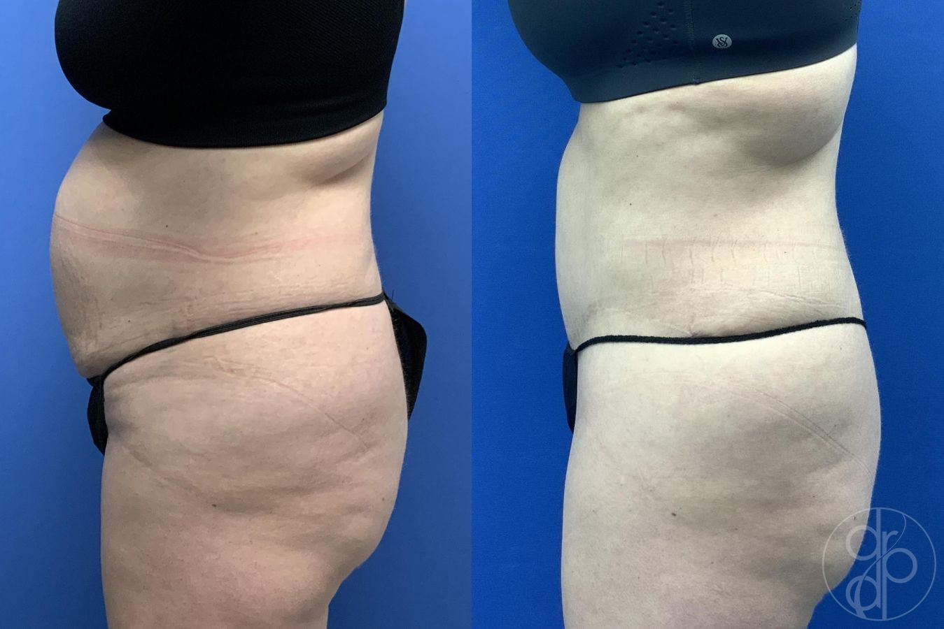 Before and after Abdominoplasty case 30018 - Angle 4