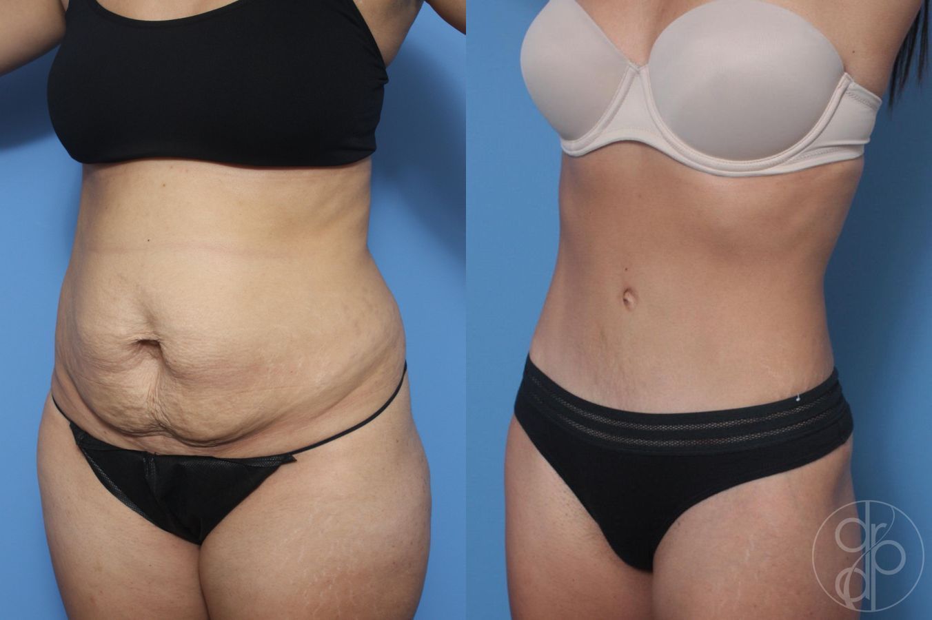 Before and after Liposuction case 29531 - Angle 2