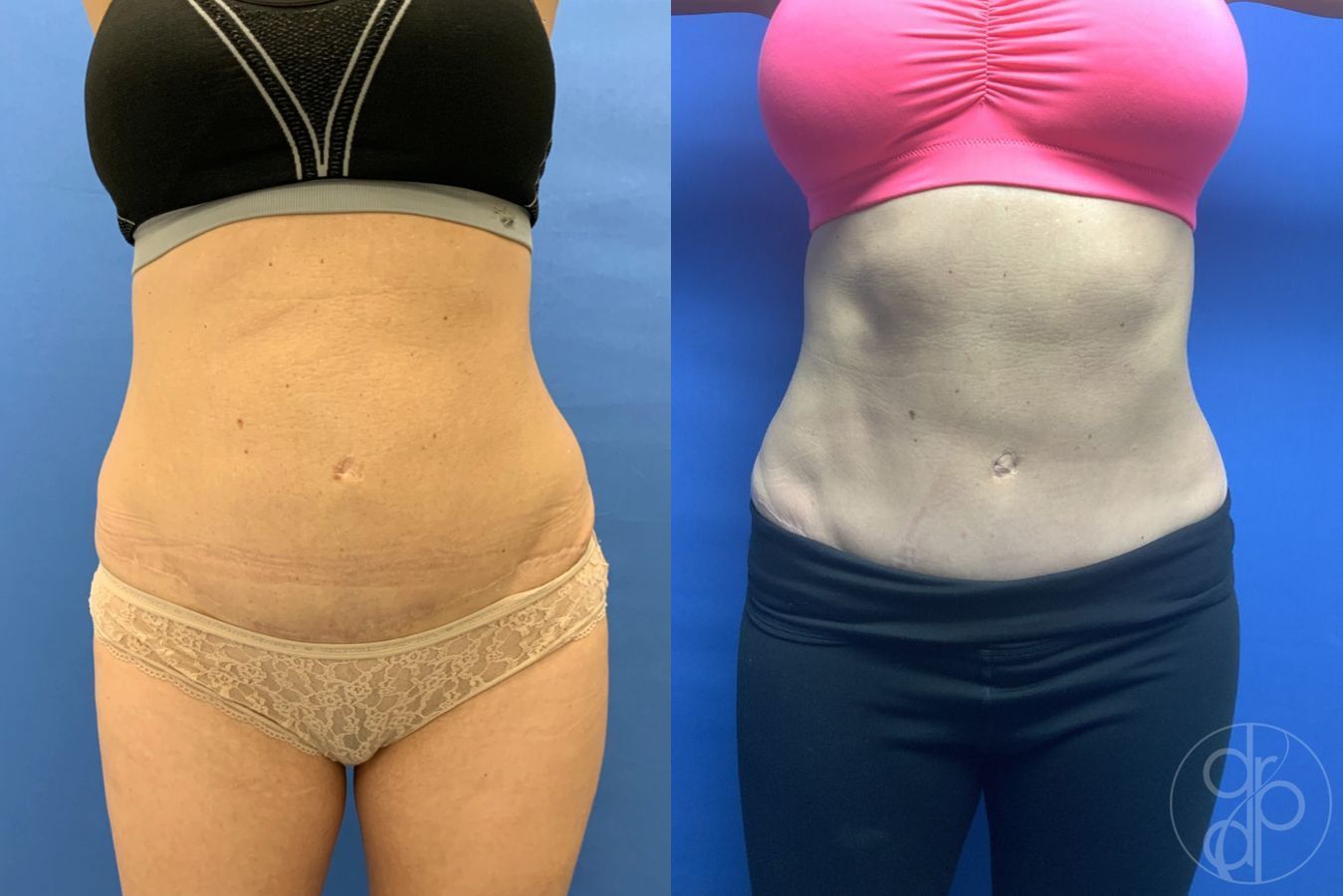 Before and after Abdominoplasty case 29572