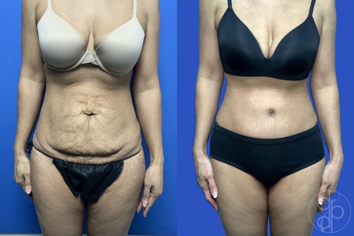 Before and after Abdominoplasty case 29540
