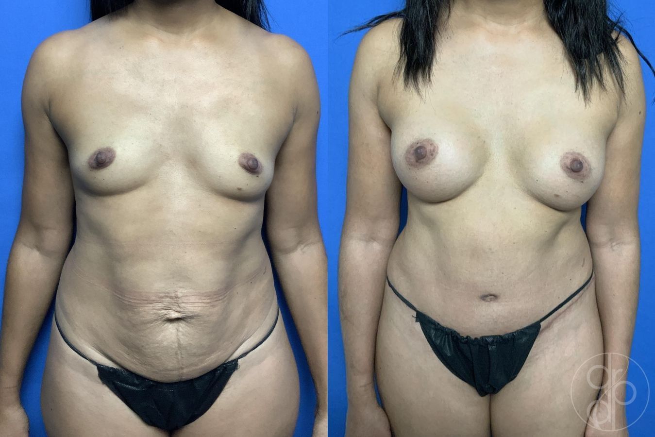 Before and after Abdominoplasty case 29685