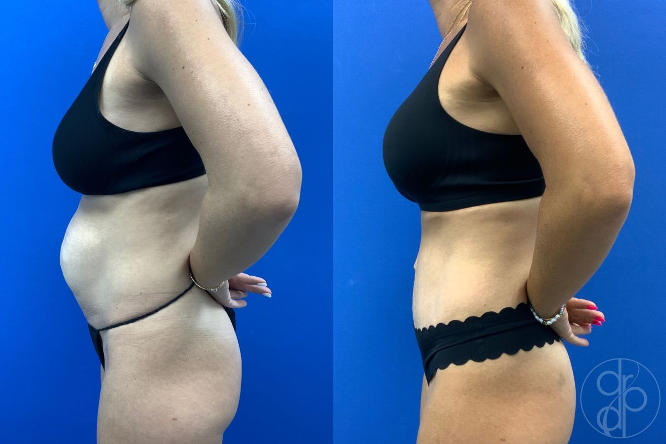 Before and after Abdominoplasty case 49485 - Angle 4