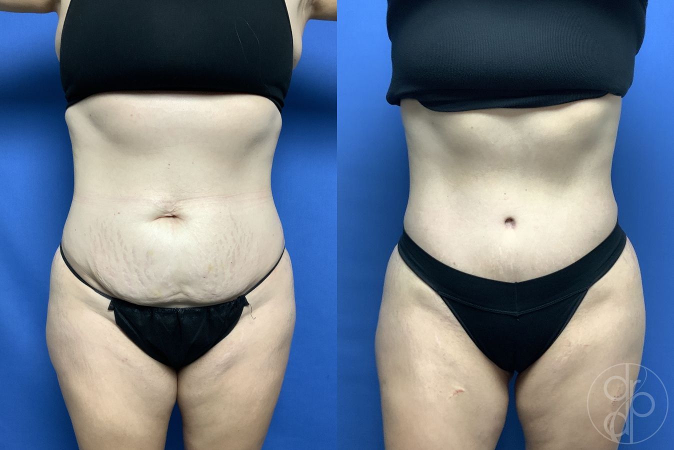 Before and after Abdominoplasty case 29538