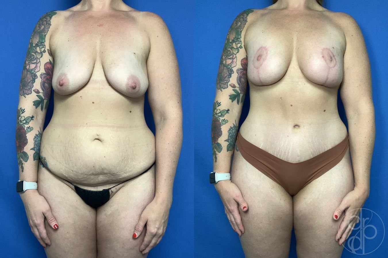 Before and after Abdominoplasty case 29689