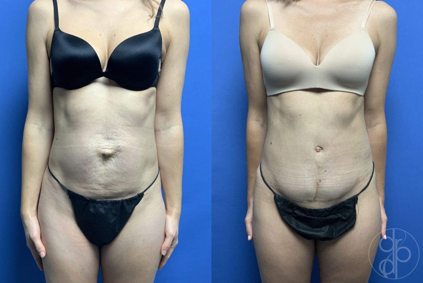 Before and after Abdominoplasty case 29567