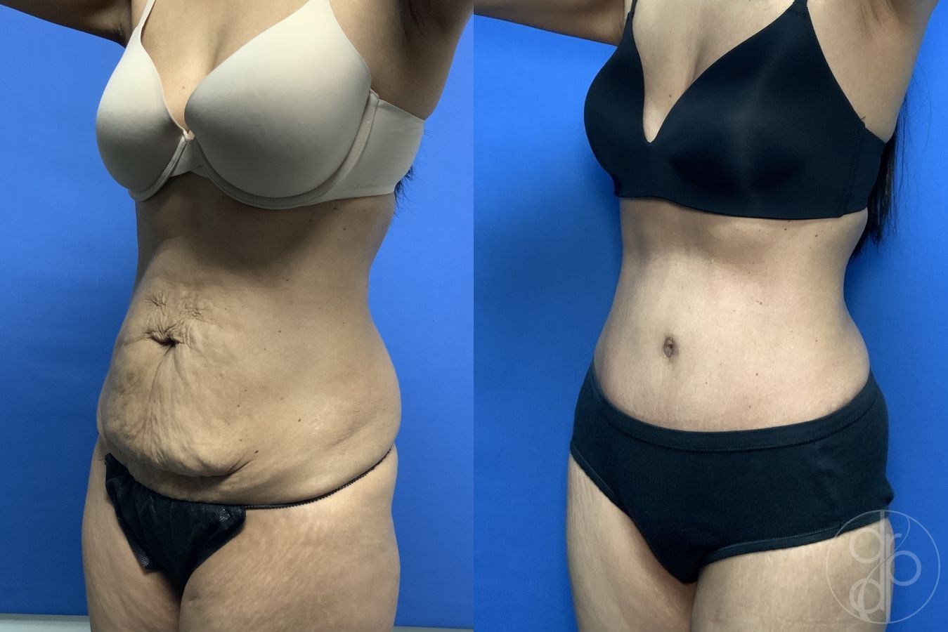 Before and after Abdominoplasty case 29540 - Angle 2