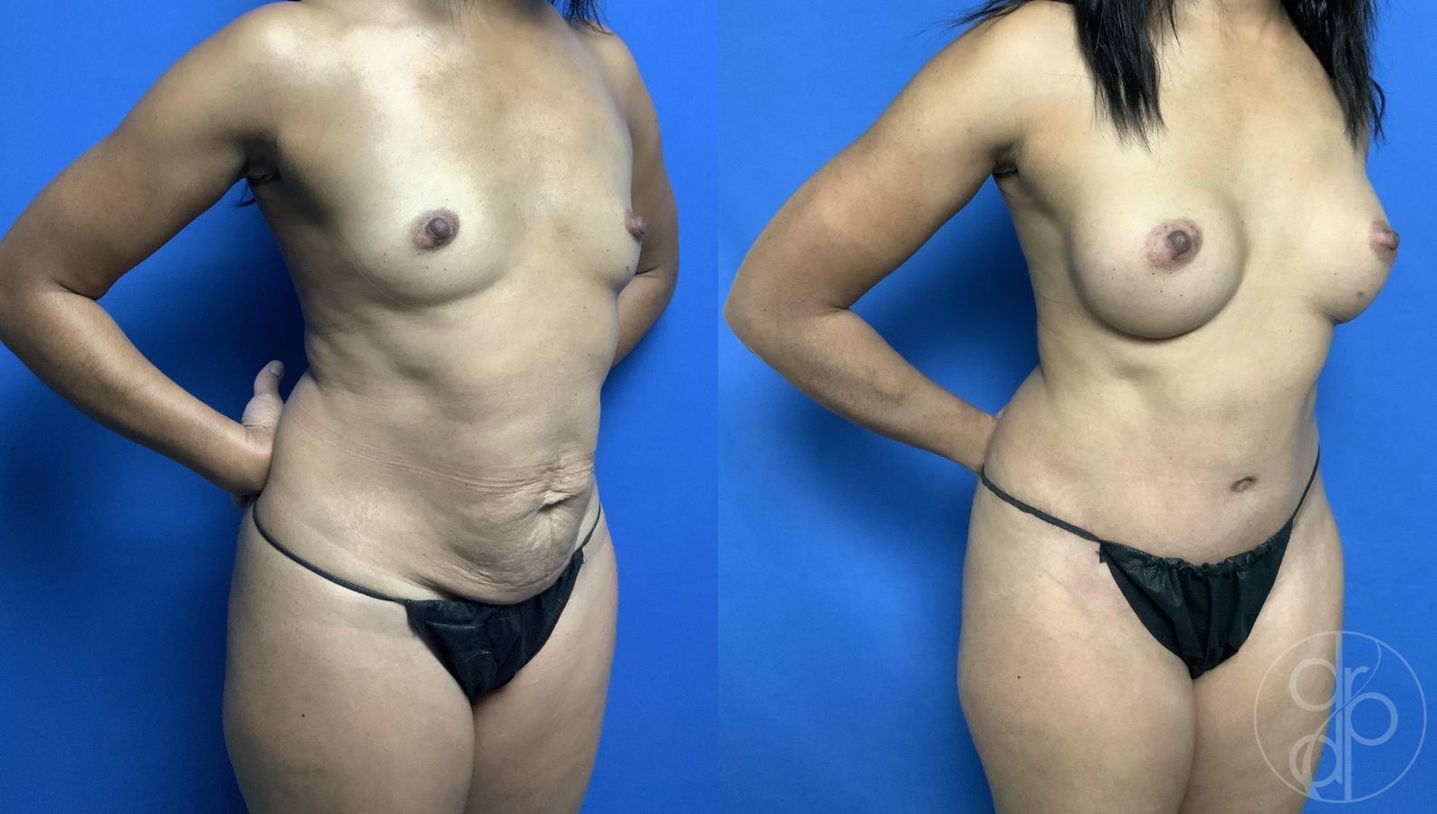 Before and after Abdominoplasty case 29685 - Angle 2