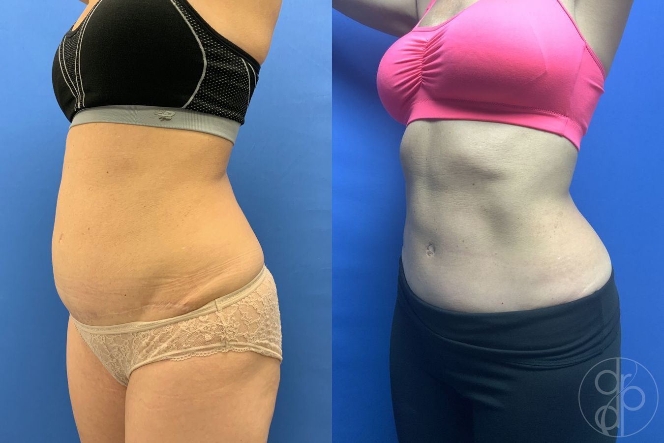 Before and after Abdominoplasty case 29572 - Angle 3