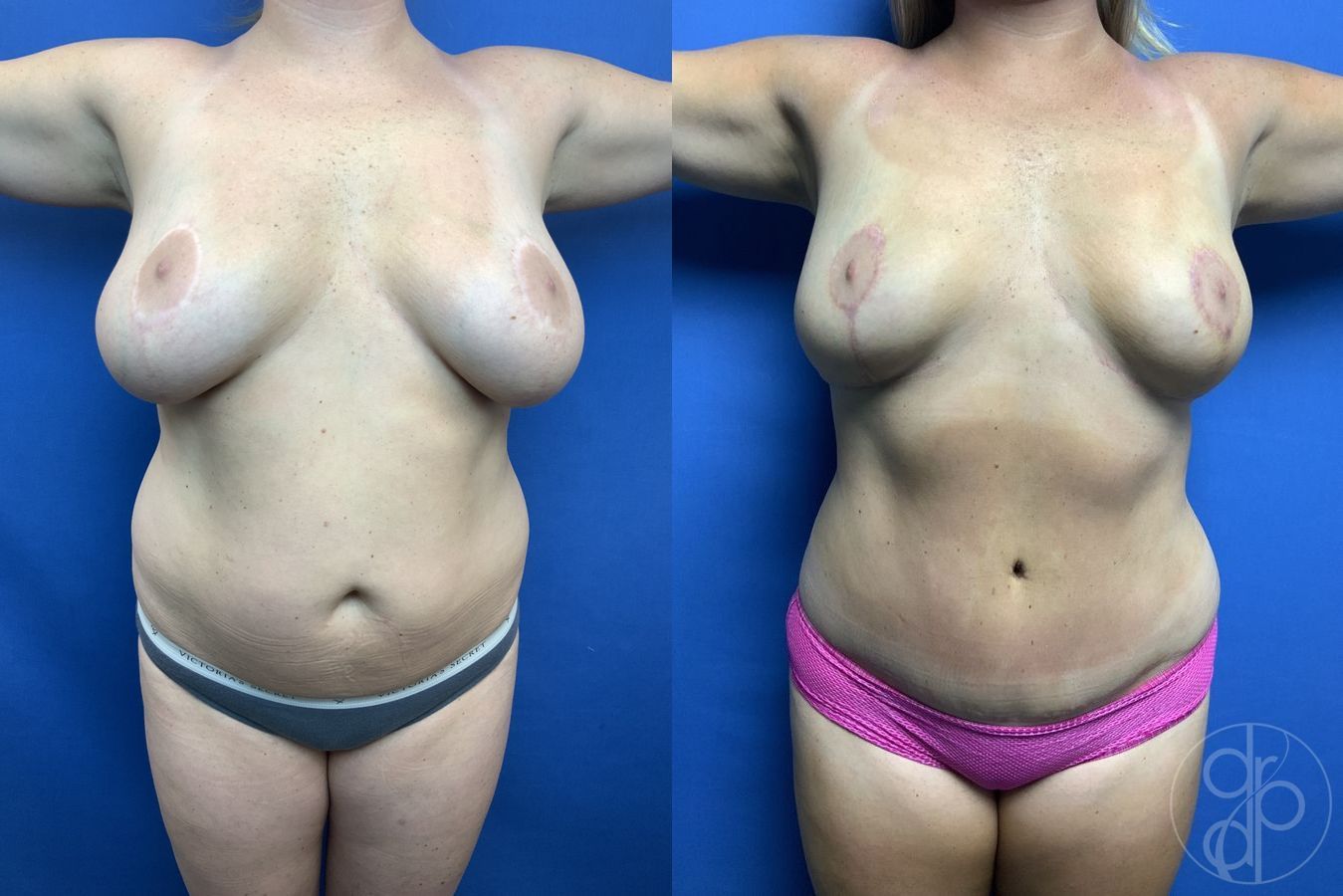 Before and after Abdominoplasty case 29691