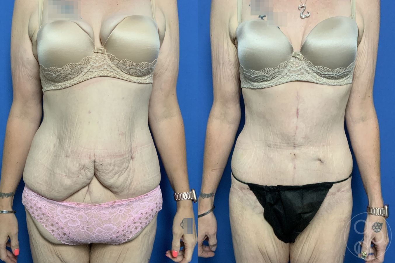 Abdominoplasty - Case 269