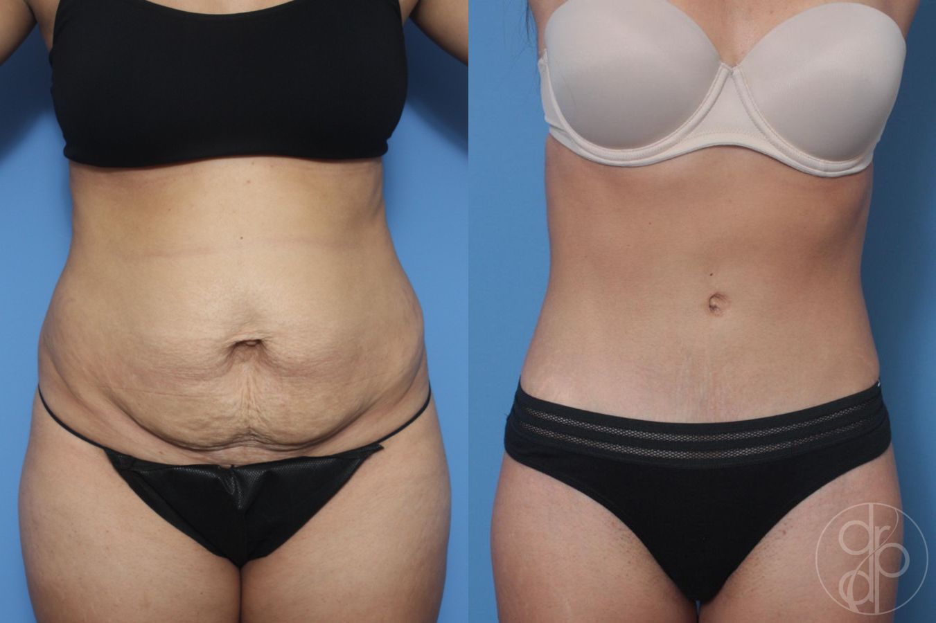 Before and after Liposuction case 29531