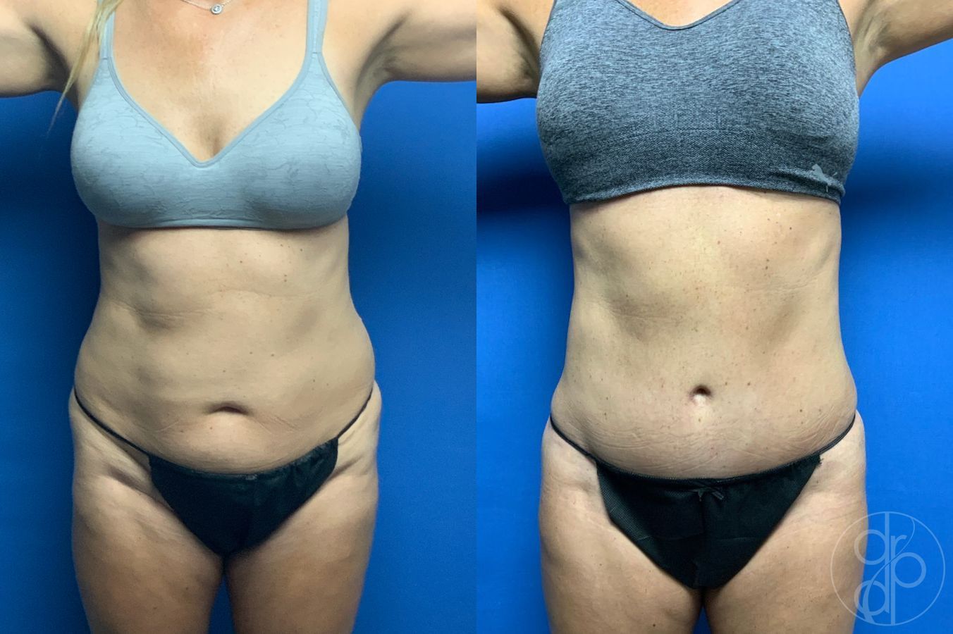 Before and after Liposuction case 46422 - Angle 2