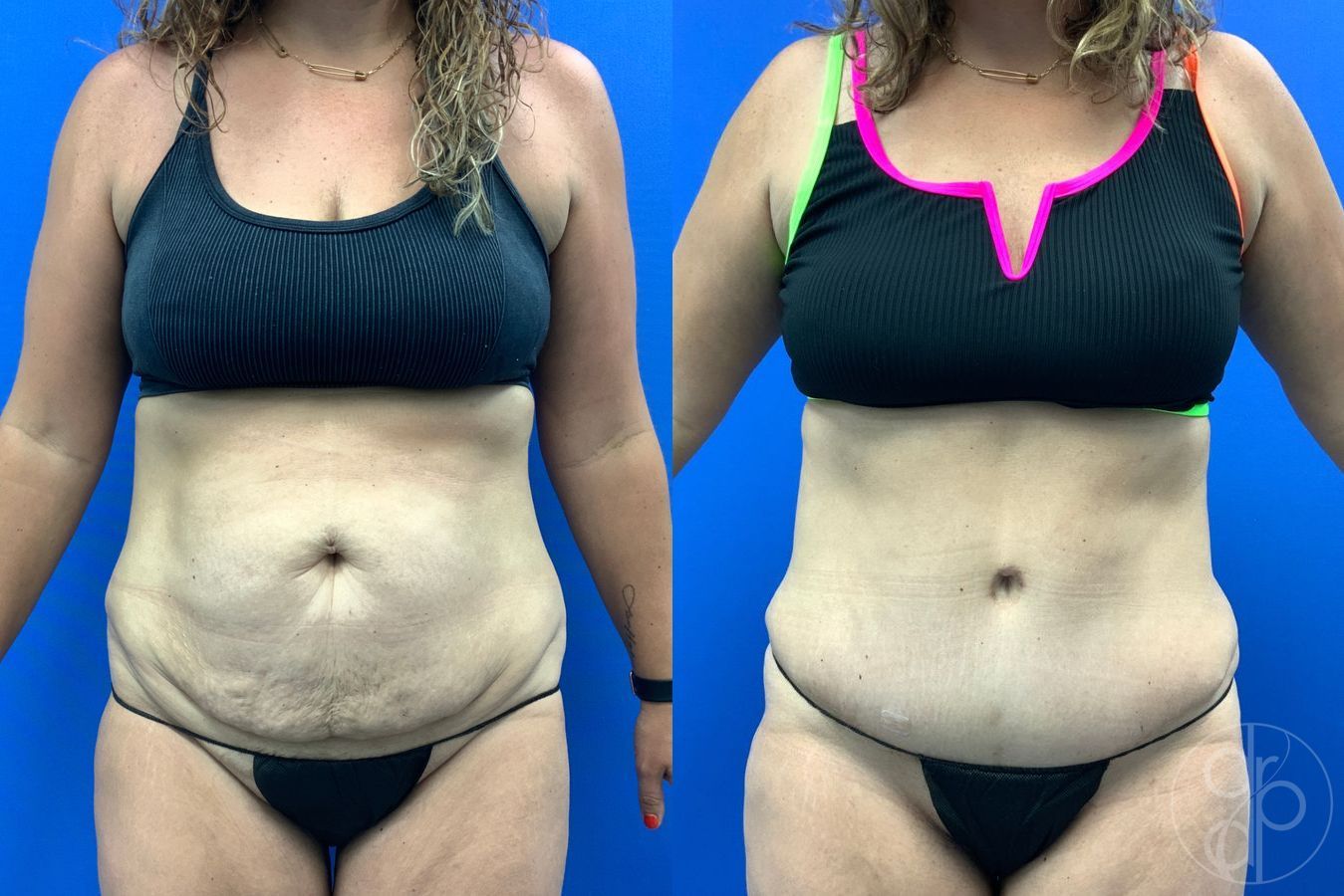 Before and after Liposuction case 43452