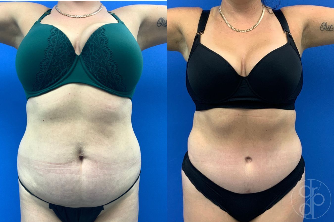 Before and after Liposuction case 43486
