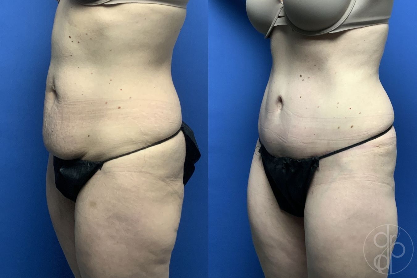 Abdominoplasty - Thumbnail 3