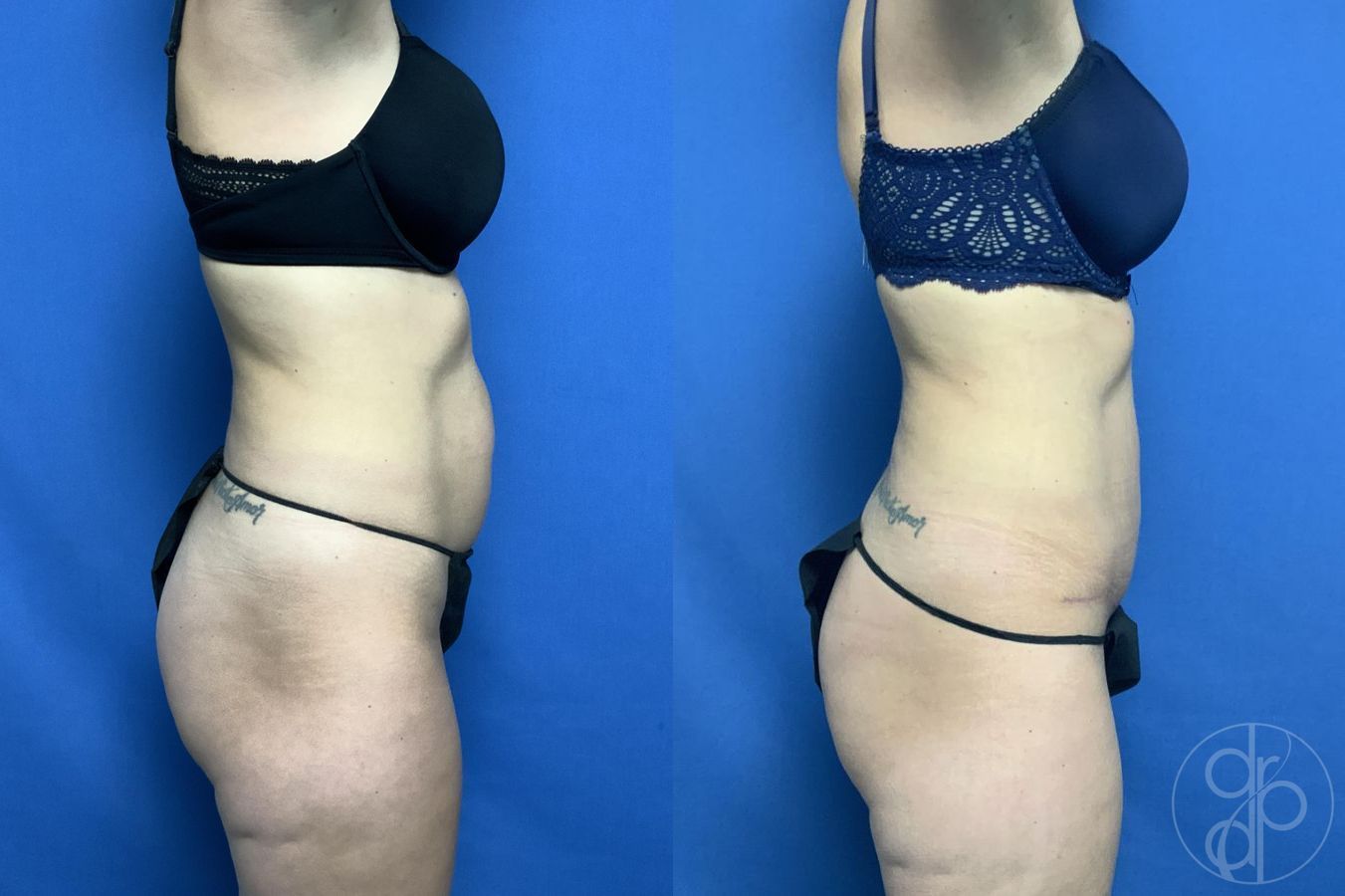 Before and after Abdominoplasty case 29573 - Angle 2
