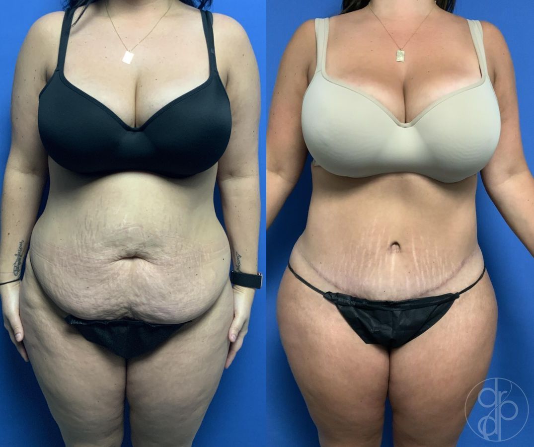 Before and after Abdominoplasty case 29578