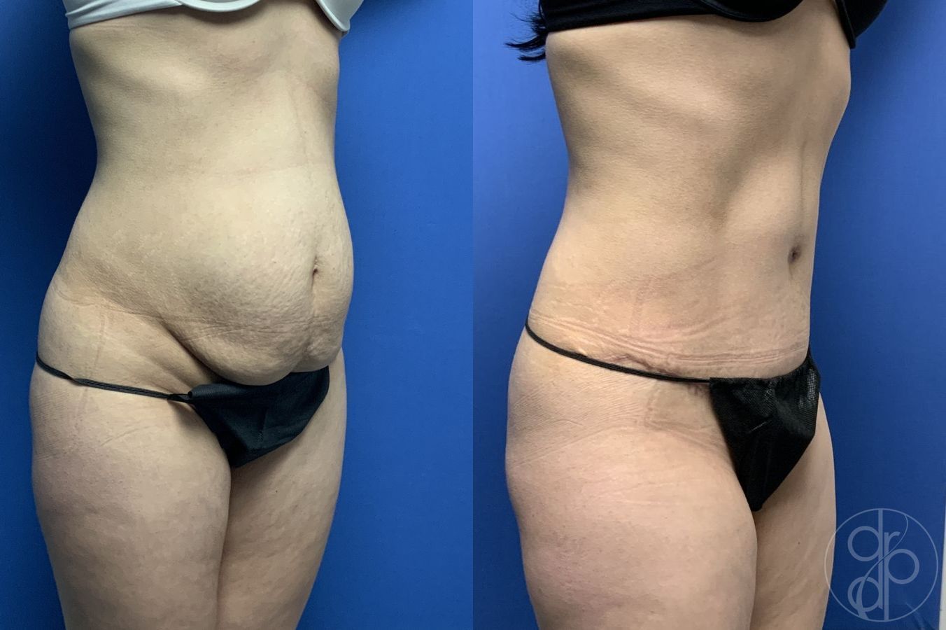 Before and after Abdominoplasty case 29565 - Angle 3