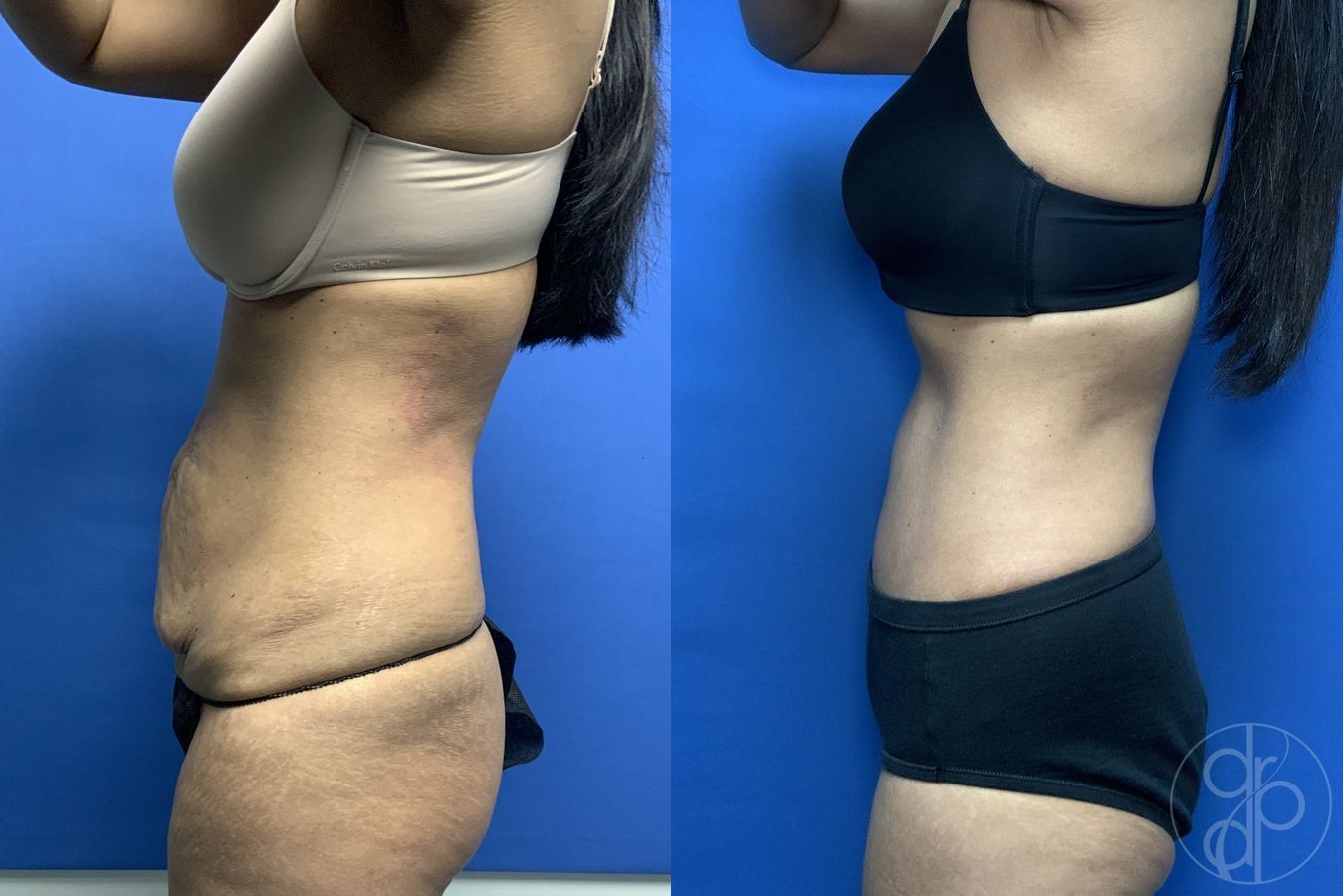 Before and after Abdominoplasty case 29540 - Angle 3
