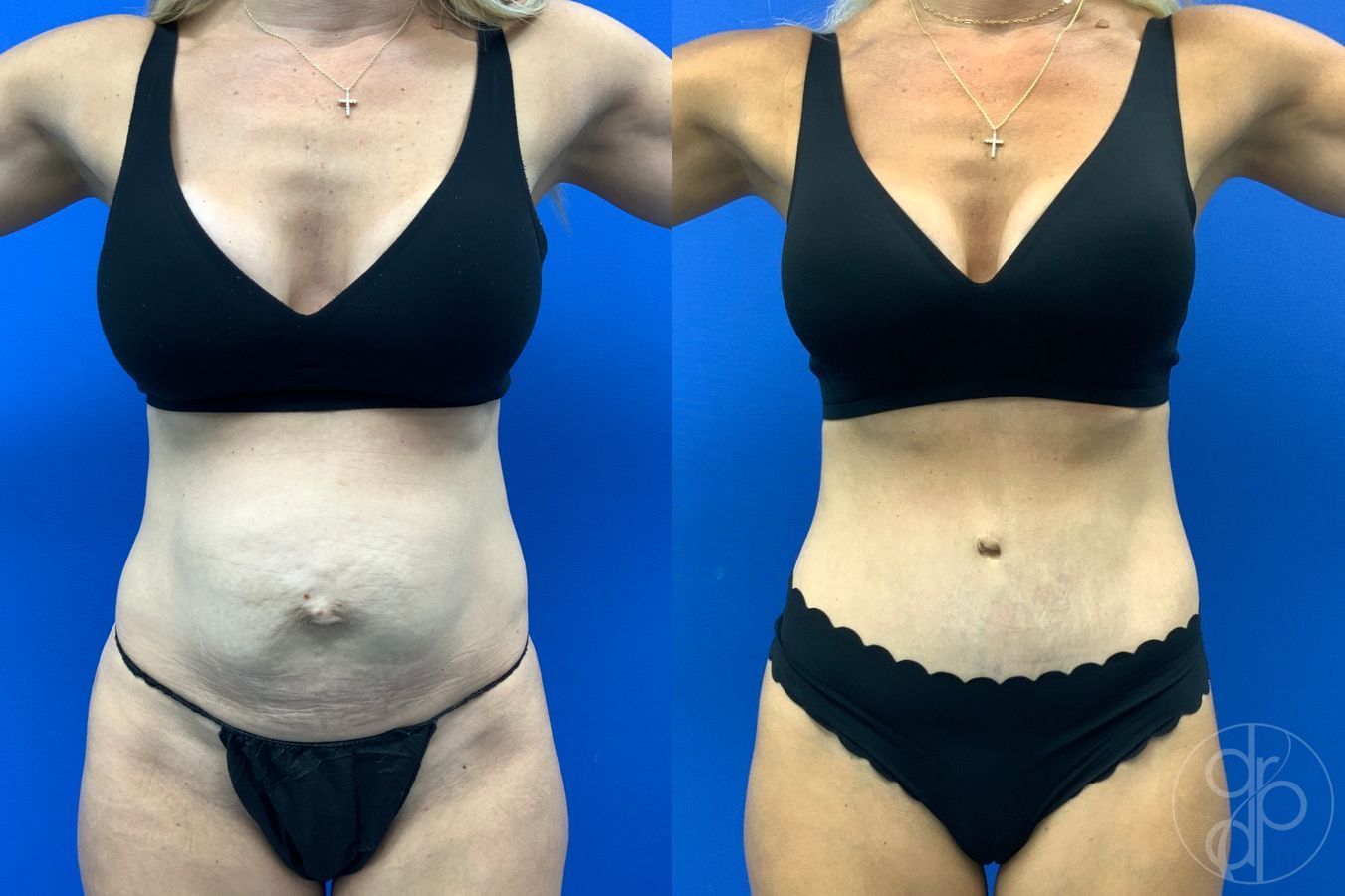Before and after Abdominoplasty case 49485 - Angle 2