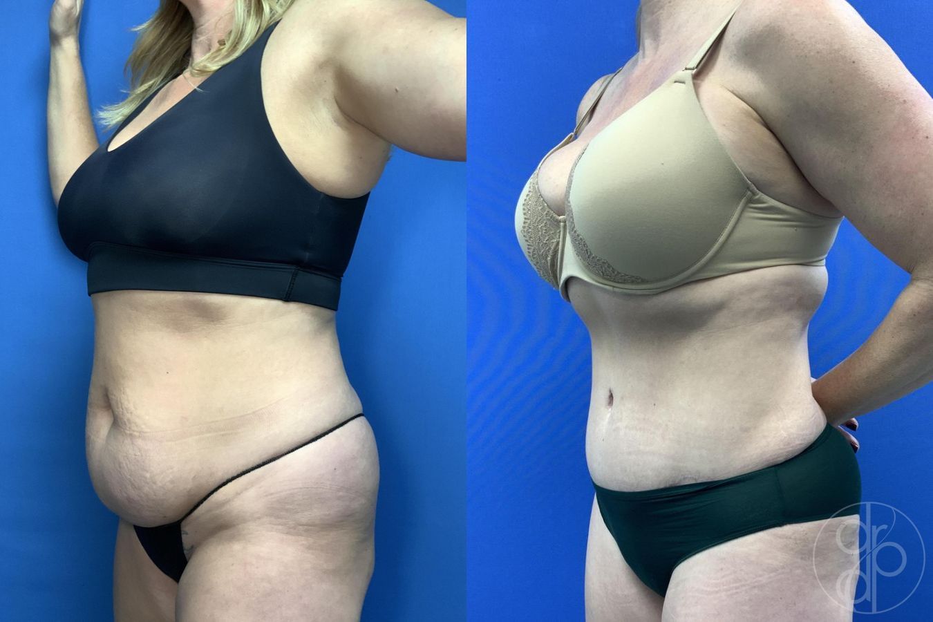 Before and after Abdominoplasty case 29762 - Angle 4