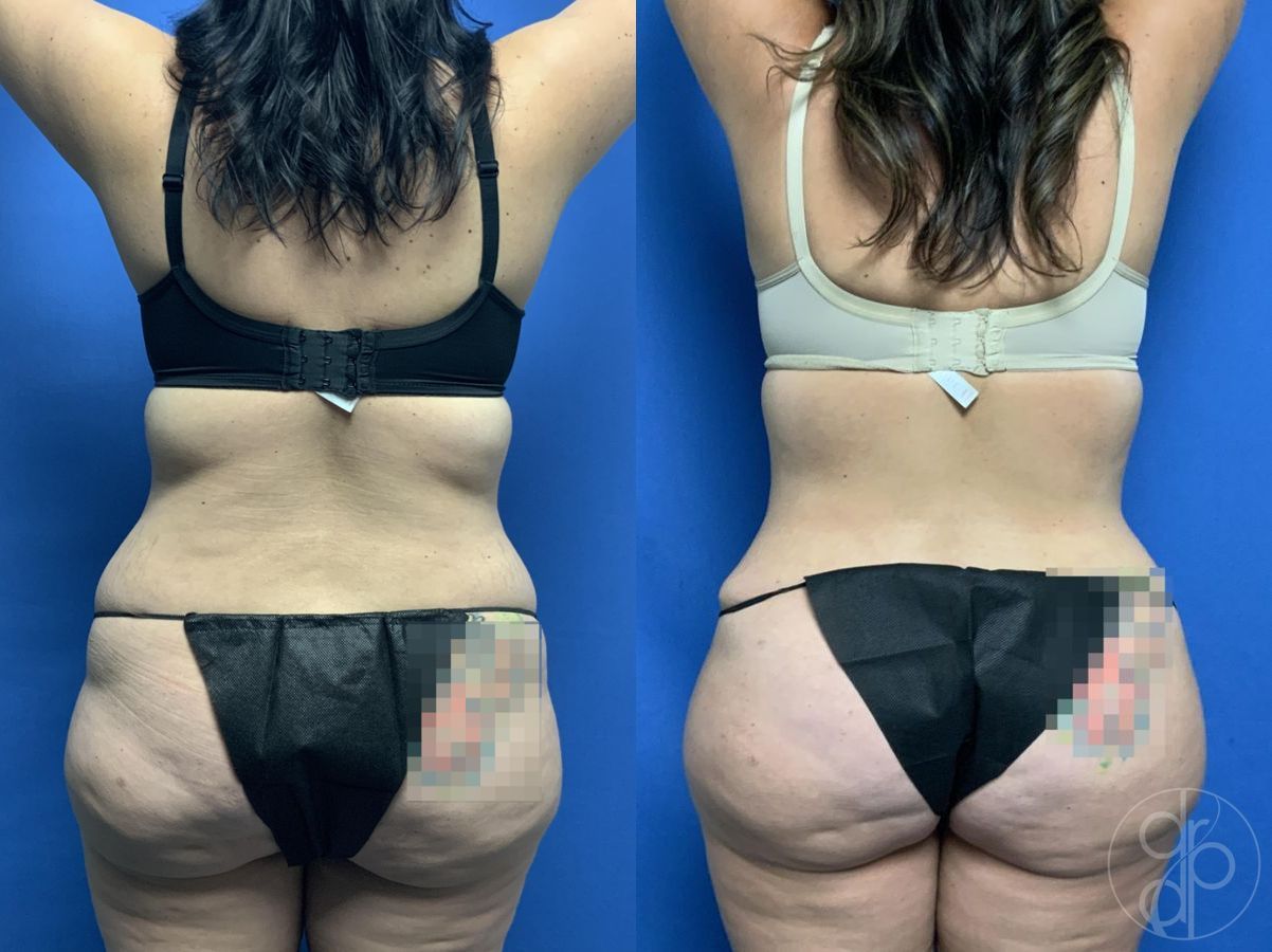 Before and after Abdominoplasty case 29578 - Angle 4