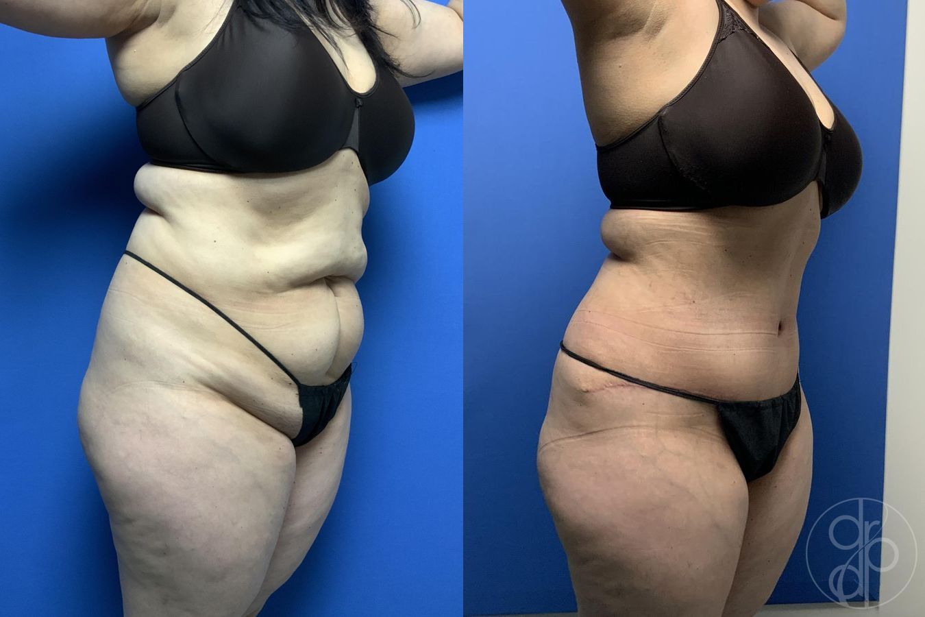 Before and after Abdominoplasty case 29569 - Angle 2