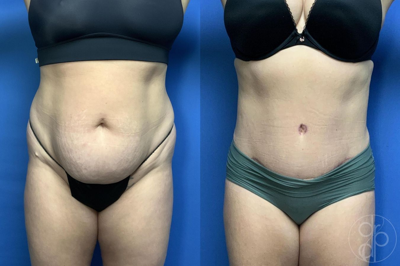Before and after Abdominoplasty case 29993