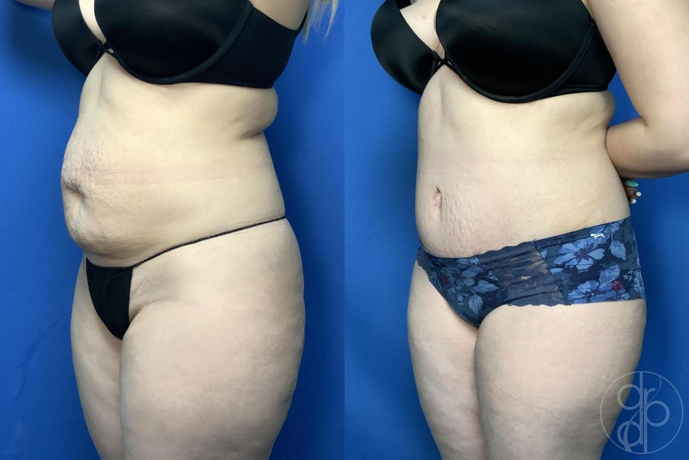 Before and after Abdominoplasty case 30006 - Angle 3