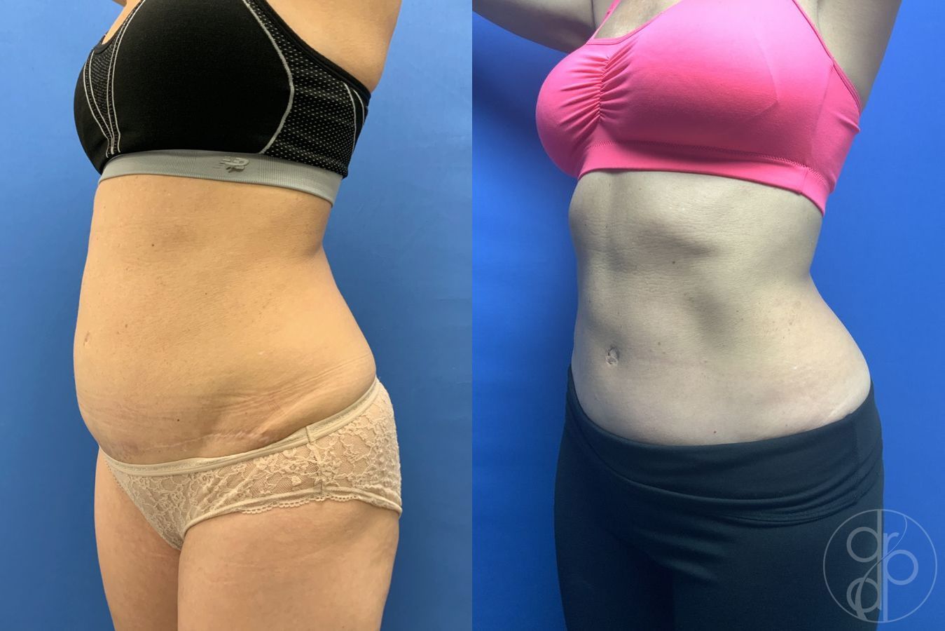 Before and after Abdominoplasty case 29572 - Angle 3