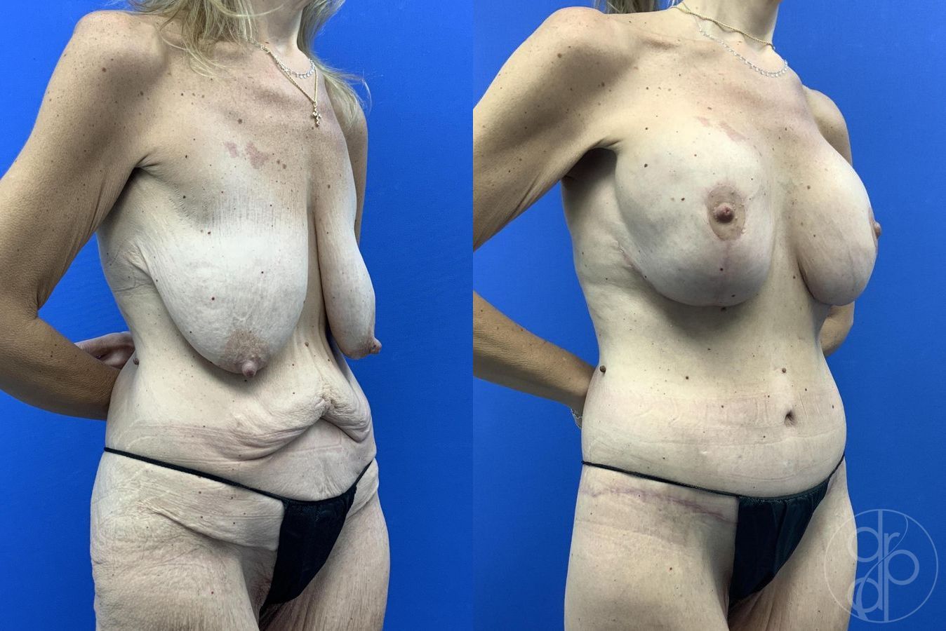 Before and after Abdominoplasty case 29983 - Angle 3