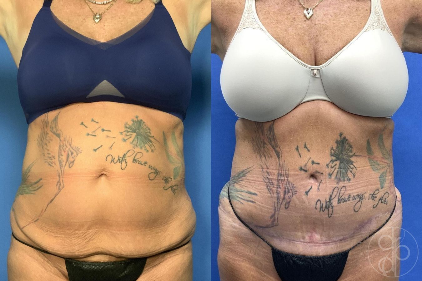 Before and after Abdominoplasty case 30022 - Angle 2