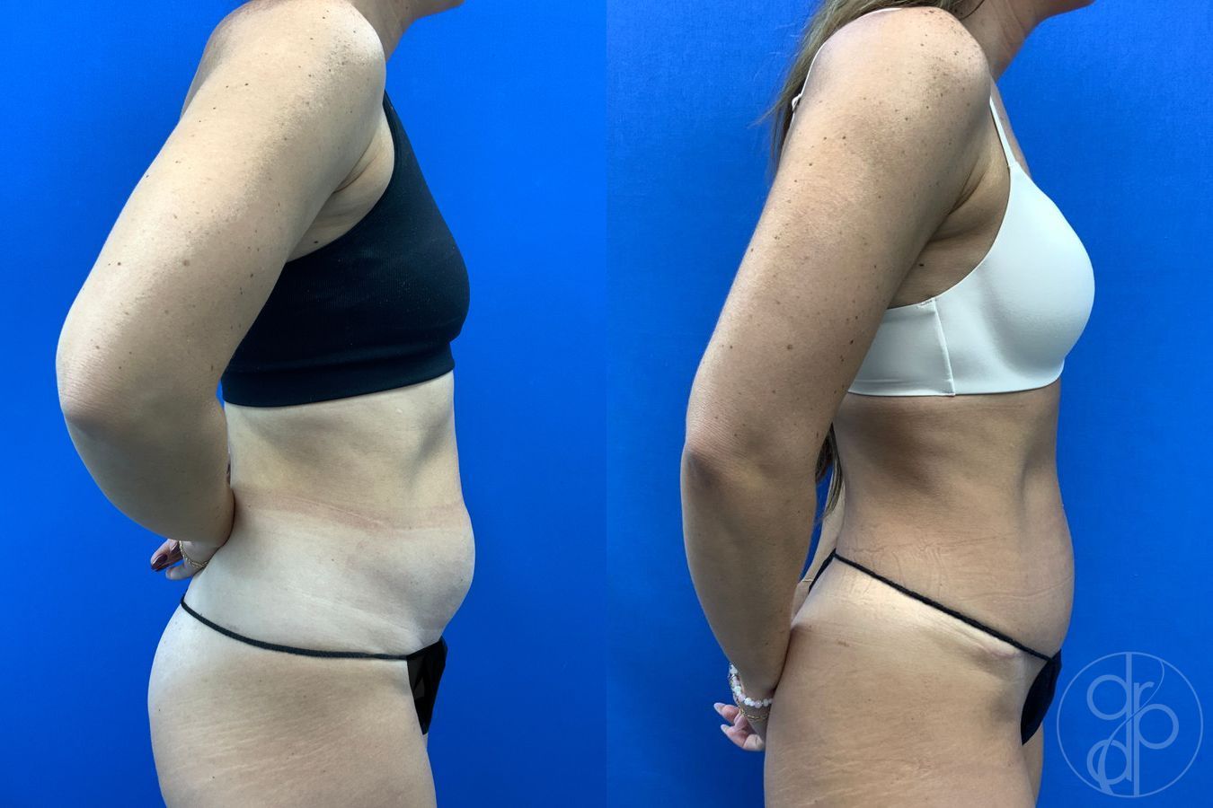 Before and after Abdominoplasty case 43175 - Angle 4