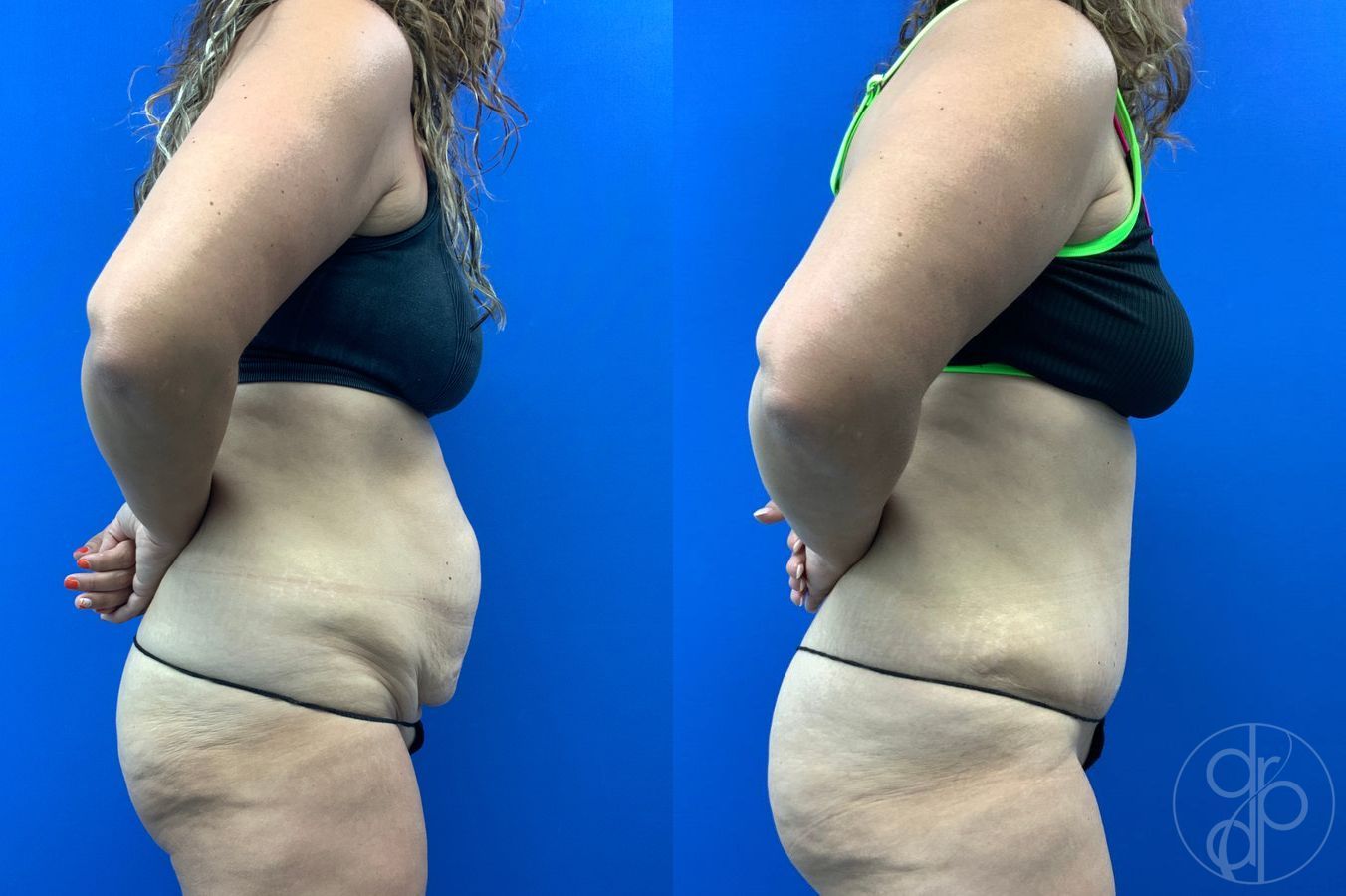 Before and after Liposuction case 43452 - Angle 4