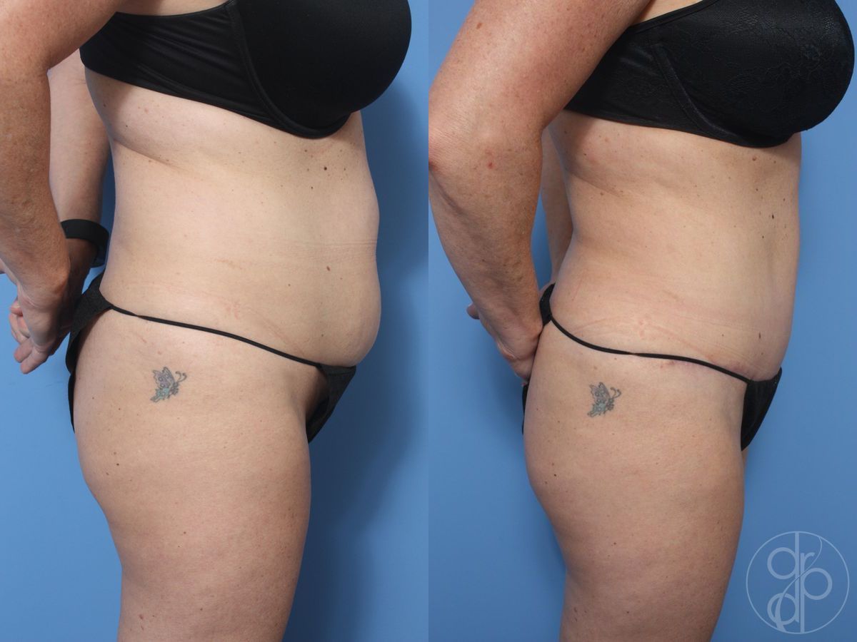 Before and after Abdominoplasty case 29527 - Angle 2
