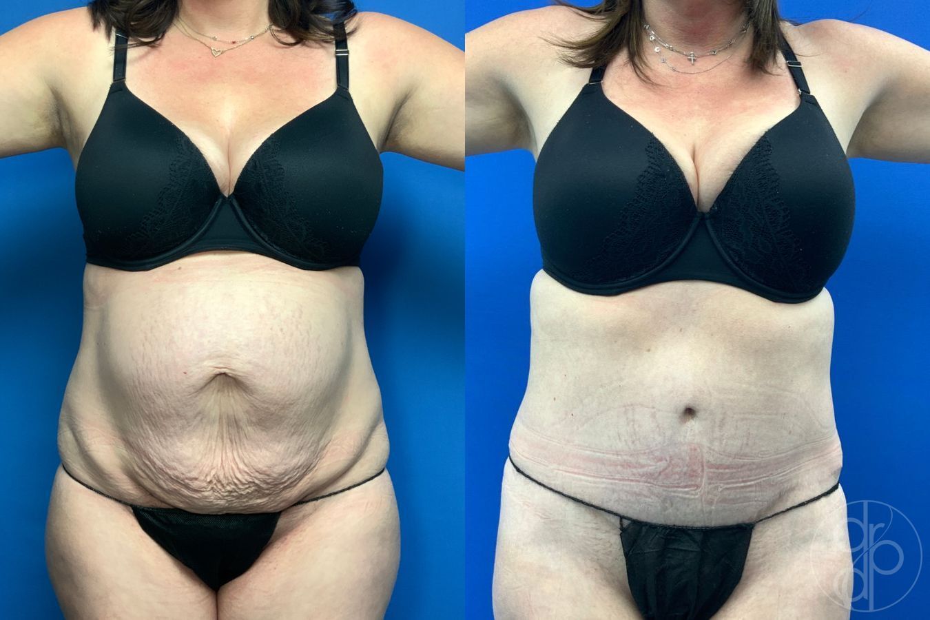 Before and after Abdominoplasty case 43192 - Angle 2