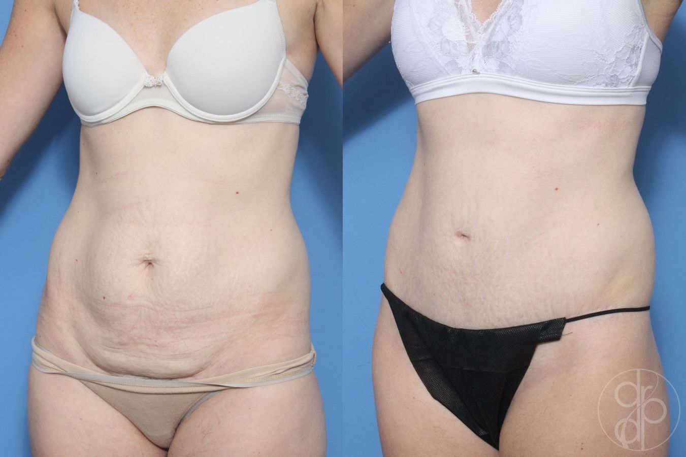 Before and after Abdominoplasty case 29570 - Angle 3