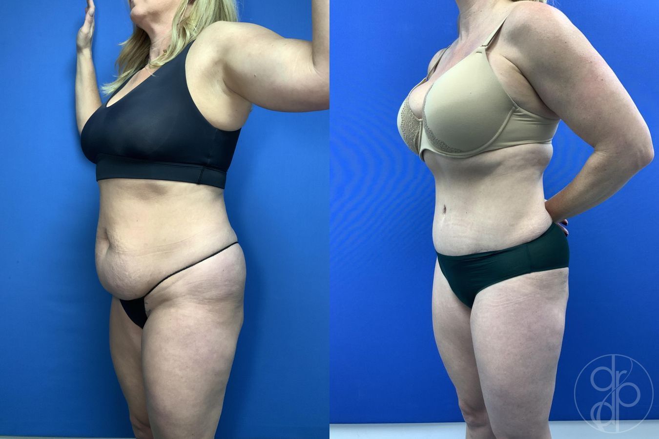 Before and after Abdominoplasty case 29762 - Angle 4