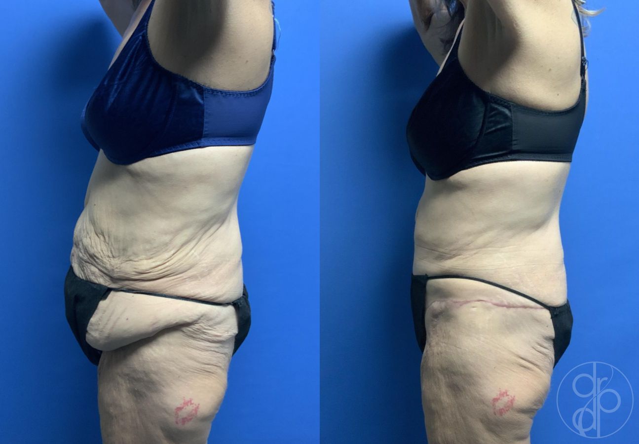 Before and after Abdominoplasty case 29528 - Angle 2