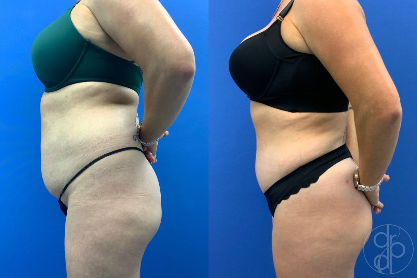 Before and after Liposuction case 43486 - Angle 7