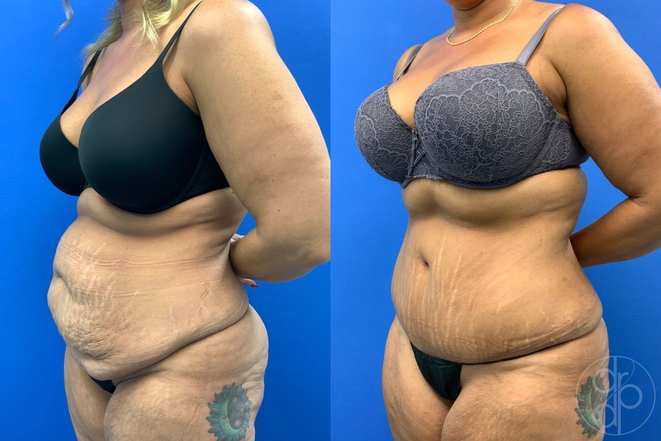 Before and after Abdominoplasty case 43473 - Angle 3