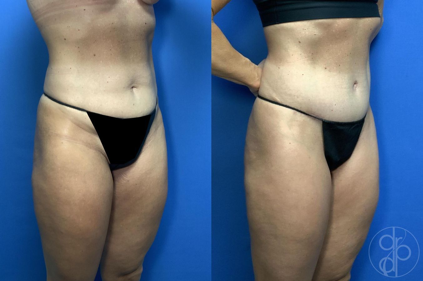 Before and after Abdominoplasty case 29994 - Angle 3