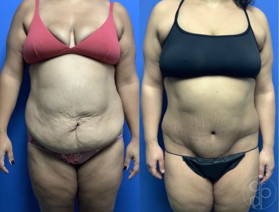 Before and after Abdominoplasty case 29566
