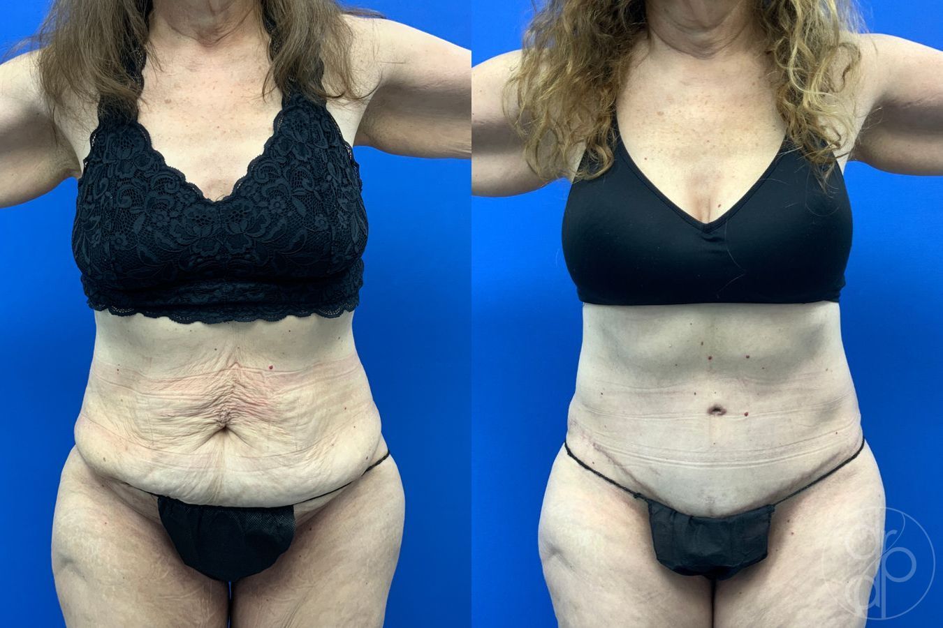 Before and after Abdominoplasty case 43198 - Angle 2