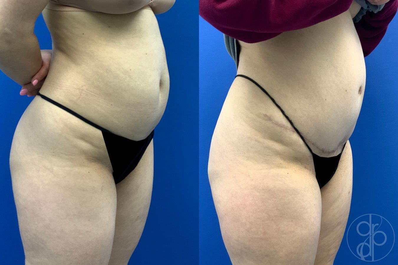 Before and after Abdominoplasty case 43481 - Angle 2