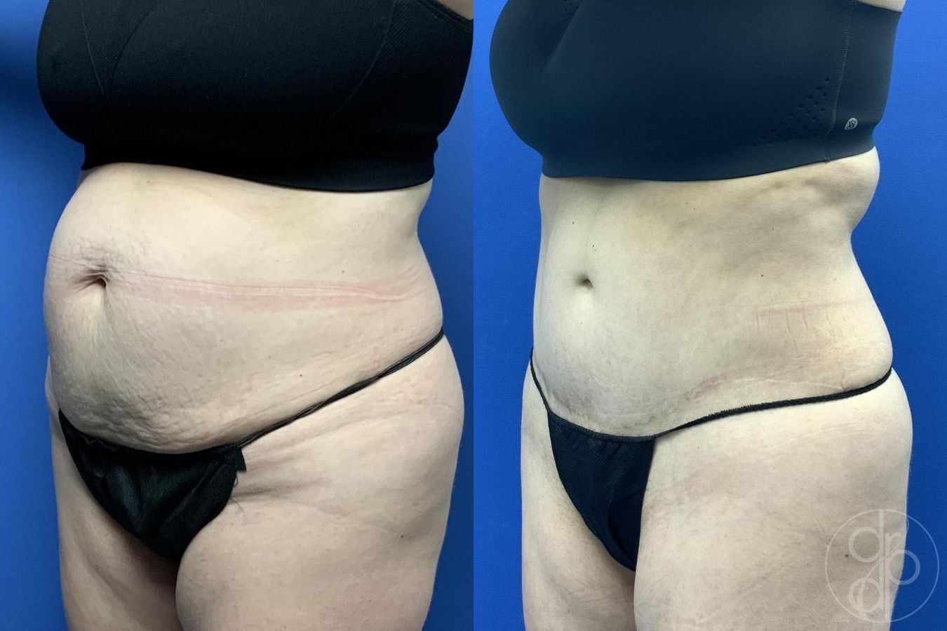 Before and after Abdominoplasty case 30018 - Angle 2