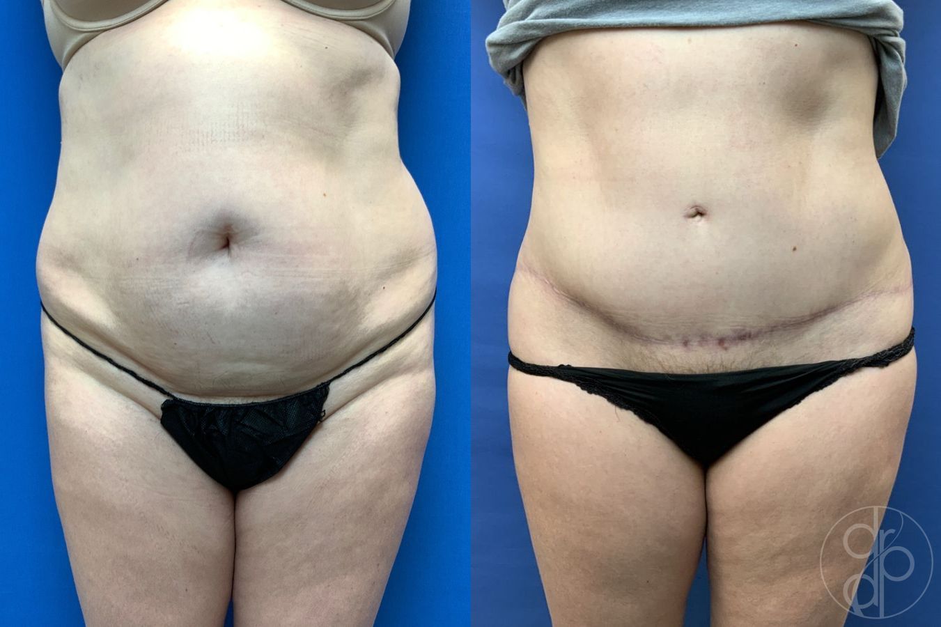 Before and after Abdominoplasty case 29579